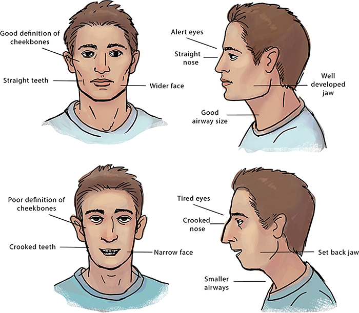 Mouth Breathing Facial Structure Comparison